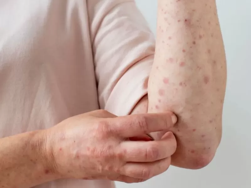 Alerta en La Plata por un contacto estrecho de la familia con sarampión que recorrió siete provincias